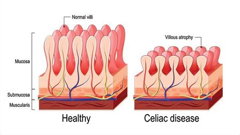 celiac disease kaumaldarius