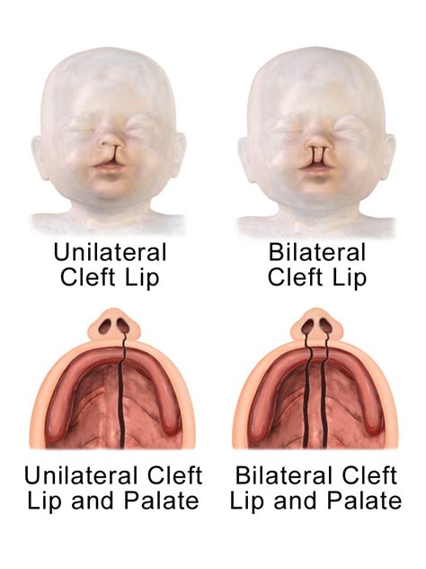 File Unilateral And Bilateral Cleft Lip And Palate Png Wikimedia Commons