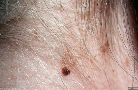 Skin Disease Types Pediculosis