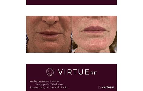 virtue rf microneedling specialist chelmsford ma   skin