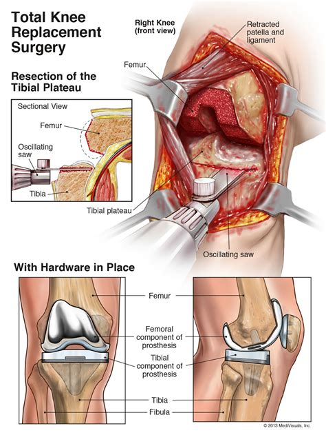 Arthroplasty Of The Knee Replacement Health Life Media
