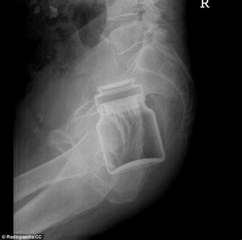 Doctors Share X Rays Of The Strangest Things They Ve Found