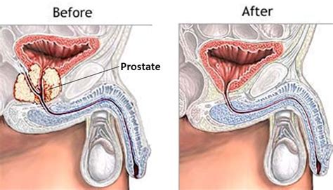 prostate cancer treatment sydney katelaris urology
