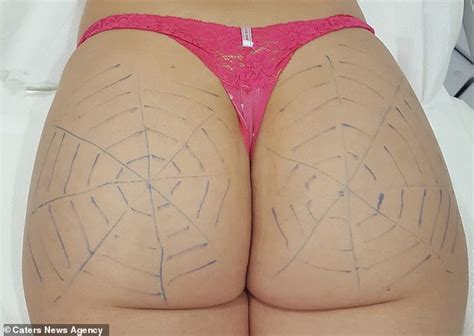 mother undergoes trendy spider web butt lift involving 100 injections daily mail online
