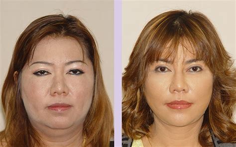 Dr Chettawut S Facial Feminization Surgery Gallery 3 2
