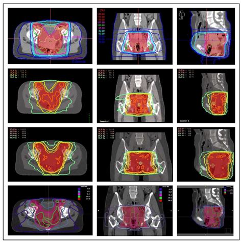 a fast radiotherapy paradigm for anal cancer with volumetric modulated
