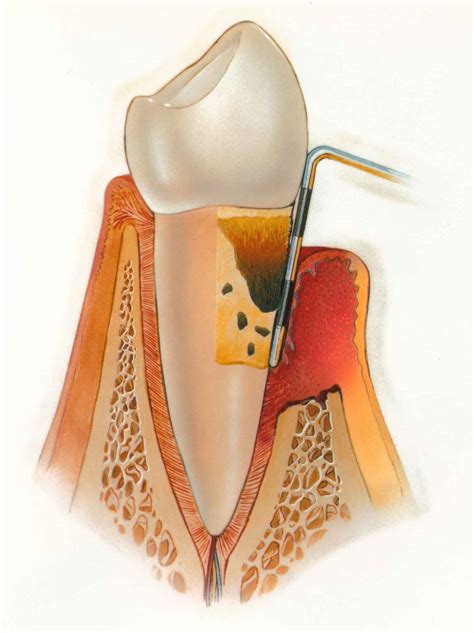 reasons    gingival flap surgery intelligent dental