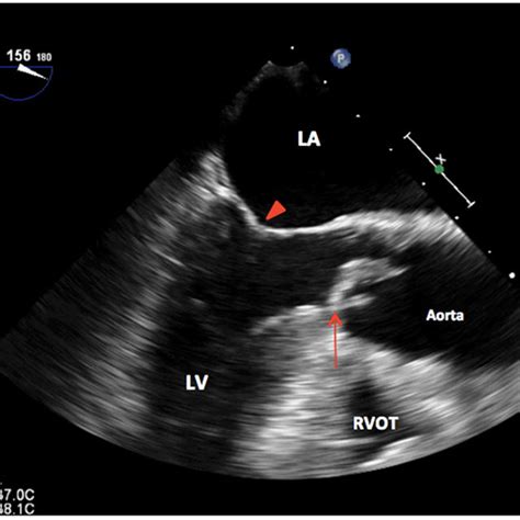 Pdf Unicuspid Aortic Stenosis In A Patient With Turner Free Nude Porn