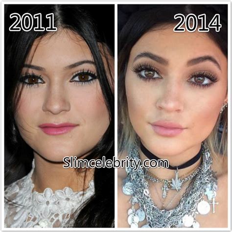 Kylie Jenner Plastic Surgery Before And After Nose Job