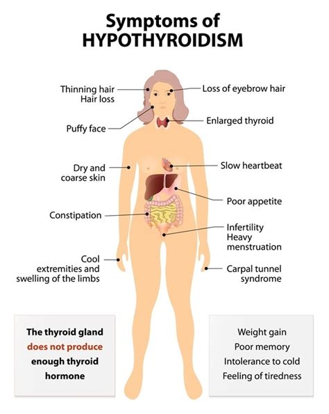 hyperthyroidism diagnosis