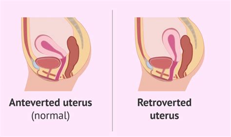 Retroverted Or Tilted Uterus An Obstacle To Your Fertility