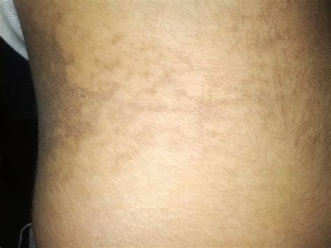 black spots  skin face  body   treatmen vrogueco