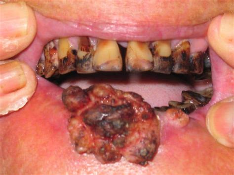 Significant Trends In Global Oral Health And Oral Cancer
