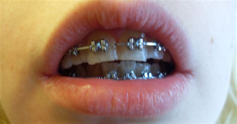 My Jaw Surgery Story 6 Months Of Braces And Appointment