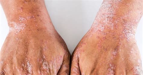 Using Natural Products Could Make Your Eczema Dermatitis Or Psoriasis