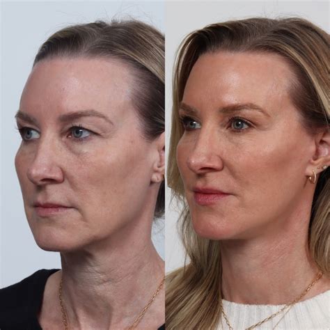Deep Plane Facelift Before And After Photos Peak Plastic Surgery Center
