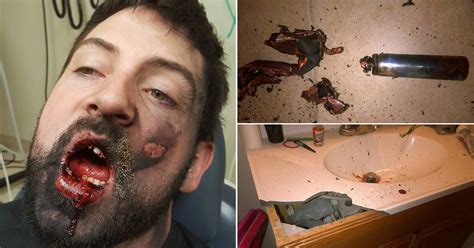 Man S Face Blown Up After E Cigarette Explodes While He S Smoking It