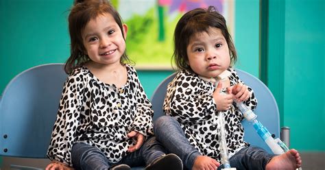 Formerly Conjoined Twins Thrive One Year After Epic Surgery
