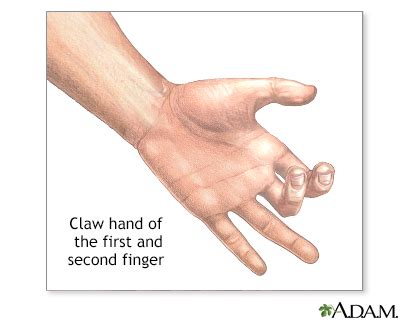 claw hand information mount sinai  york