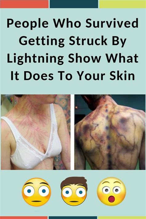 People Who Survived Getting Struck By Lightning Show What It Does To