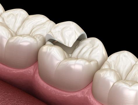 inlays  onlays treatment  dentistry  bradenton fl