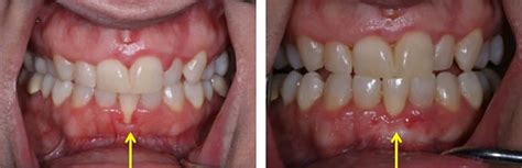 pain  gums  front teeth teethwalls