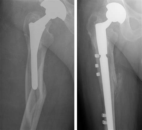 thigh pain  hip replacement  hip surgery