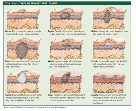 identifying skin lesions