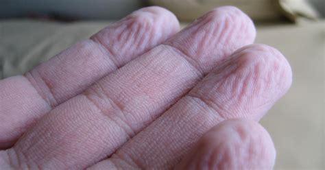 explained why fingers get wrinkly after a long bath or swim