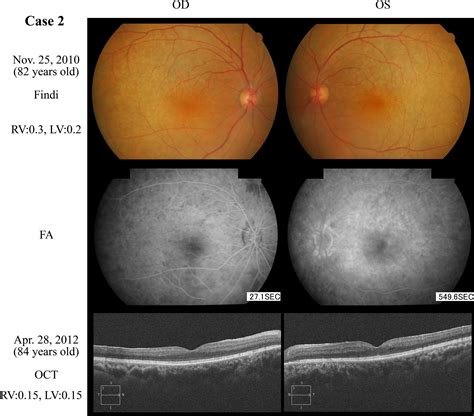 mutations  enhanced  cone syndrome ophthalmology
