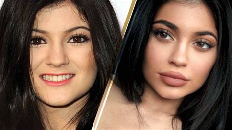 kylie jenner lip fillers plastic surgery before and after photos