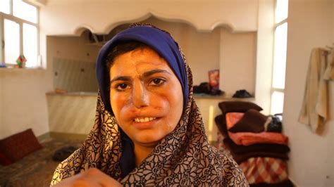 afghan wife maimed for refusing drug addict husband s cash