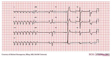 difference  afib  vfib  svt compare  difference