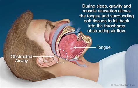snoring  sleep apnea joseph hudgins orthodontics carbondale illinois