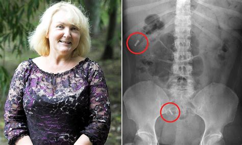 Woman Who Was Sterilised Is Horrified To Discover Metal Surgical Clip