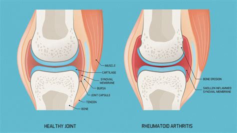 rheumatoid arthritis disease progression  overview