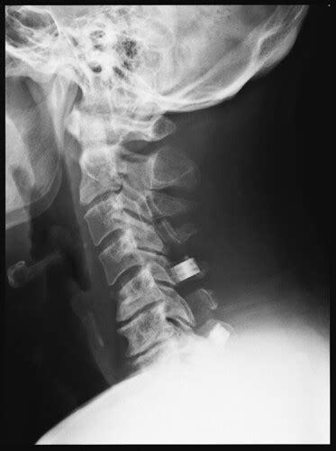 Cervical Spondylotic Myelopathy 002 Xray X Ray Pictures