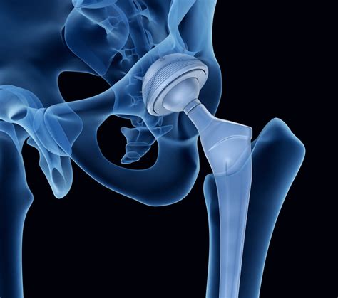 Long Term Precautions After Hip Replacement Surgery Your