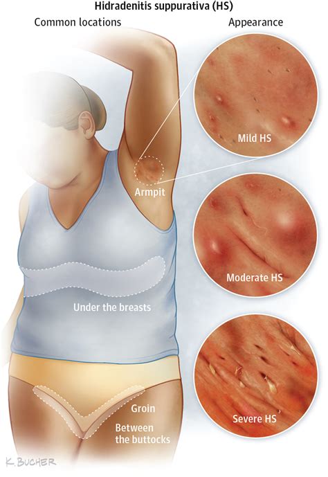 hidradenitis suppurativa dermatology jama dermatology the jama