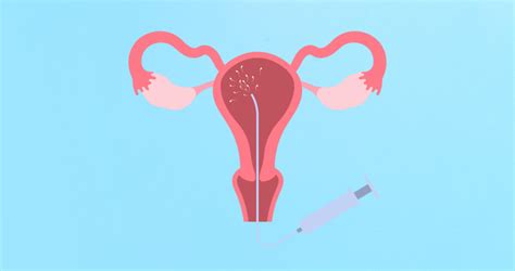 the ultimate guide to intrauterine insemination iui and its benefits