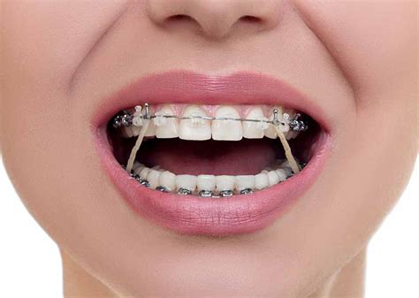 elastics rubber bands  orthodontic treatment dr meeks