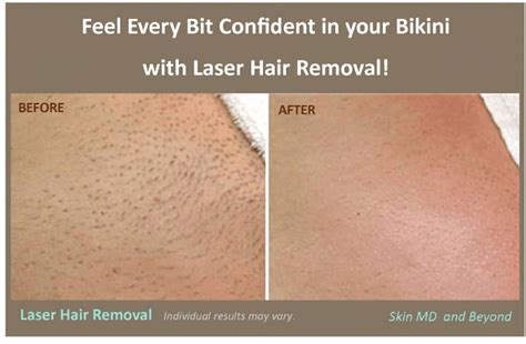 laser hair removal cosmetic skin care specialist plano tx