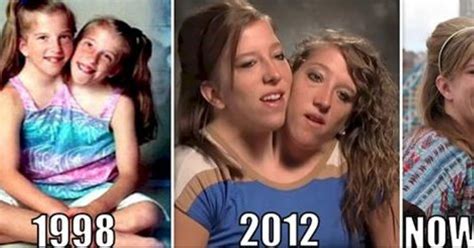 15 Unbelievable Facts About World Famous Conjoined Twins