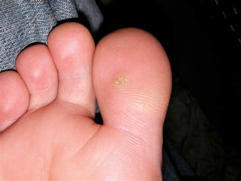 filetoe plantar wart jpg