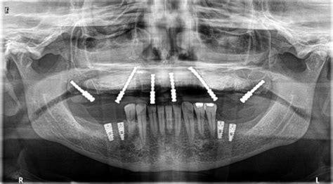 Maxillary Modification Of An “all On 4” By Placing Pterygoid Implants