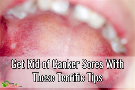 get rid of canker sores with these terrific tips home remedies