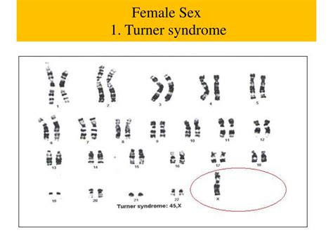 Ppt Chromosomal Abnormalities I Sdk October 13 2012 Powerpoint
