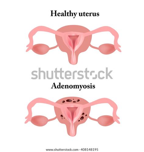 Endometriosis Structure Pelvic Organs Adenomyosis Endometrium Stock