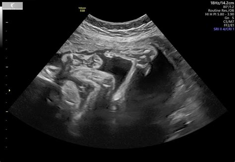 weeks ultrasound