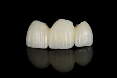 full ceramic single crowns whats  real deal stomadent